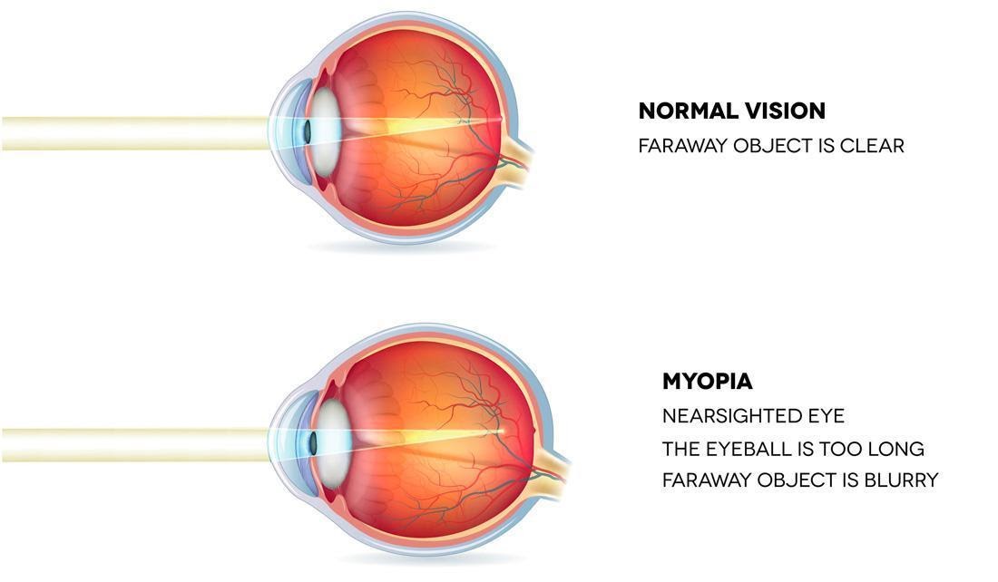 myopia illustration