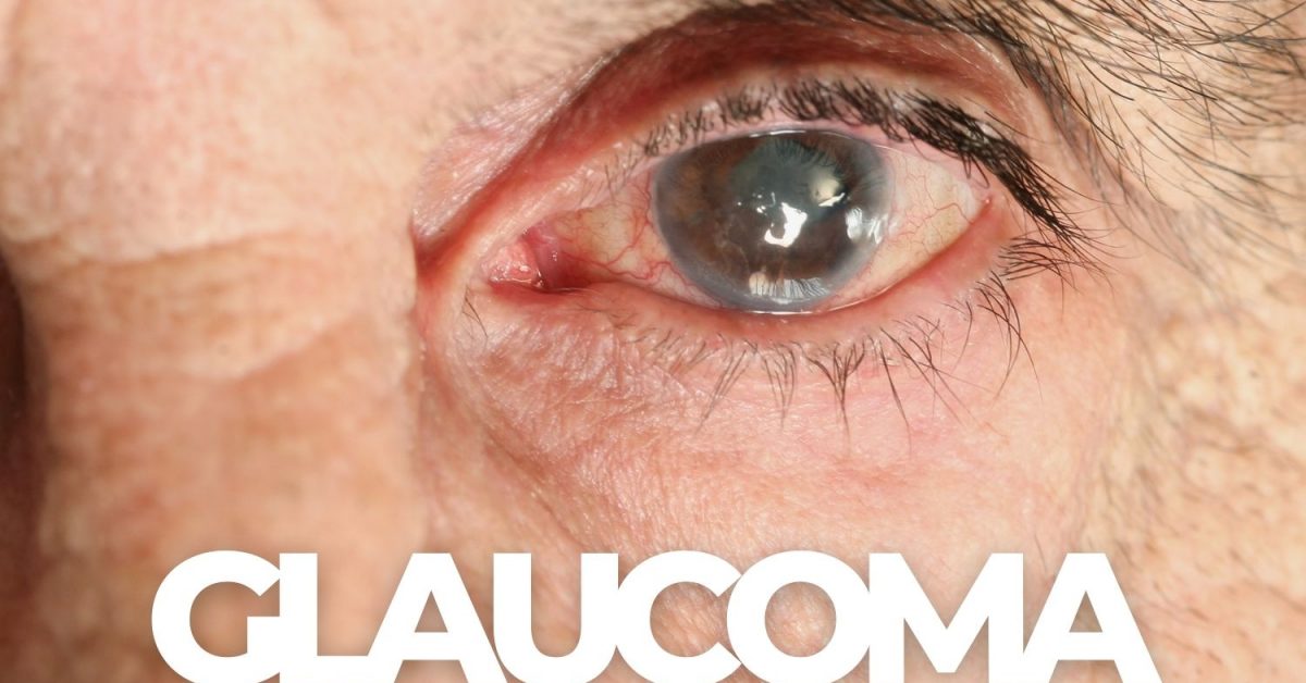 What's The First Sign Of Glaucoma? - EZOnTheEyes