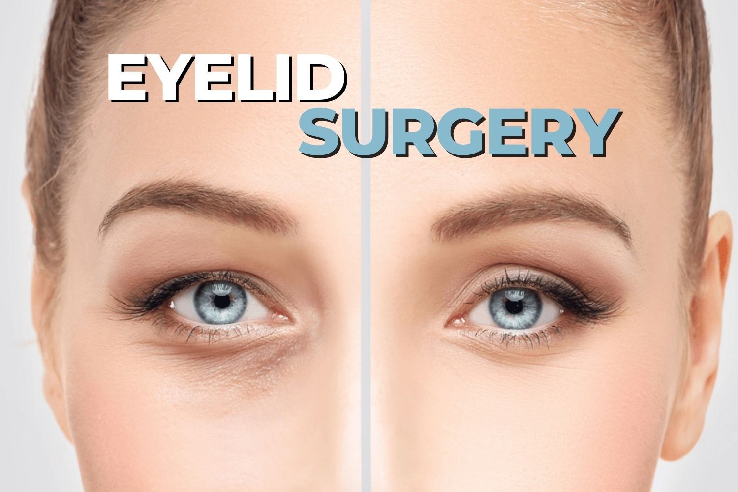 Before & After – Toronto Eyelid Surgery