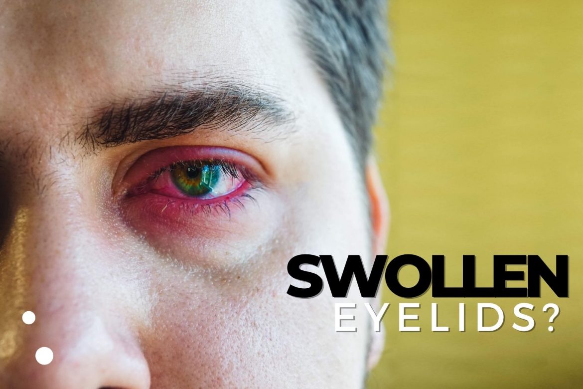 The Many Causes Of Swollen Eyelids — And What You Should Do Ezontheeyes 
