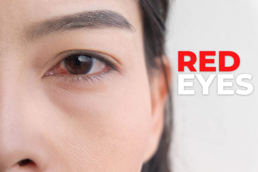 the-10-most-common-reasons-for-red-eyes-ezontheeyes