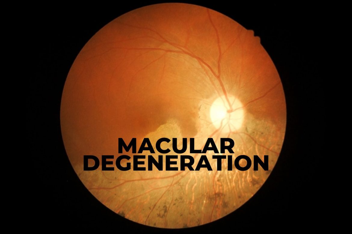 macular degeneration