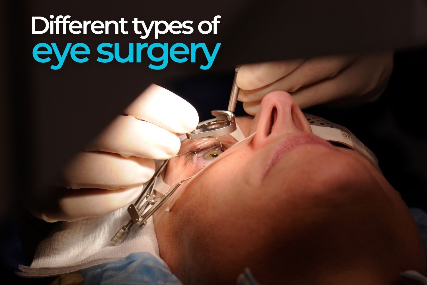 Understanding The Different Types Of Eye Surgery Ezontheeyes