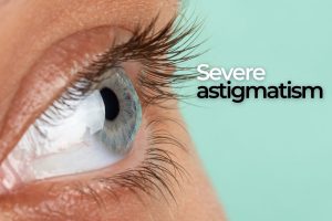 severe astigmatism