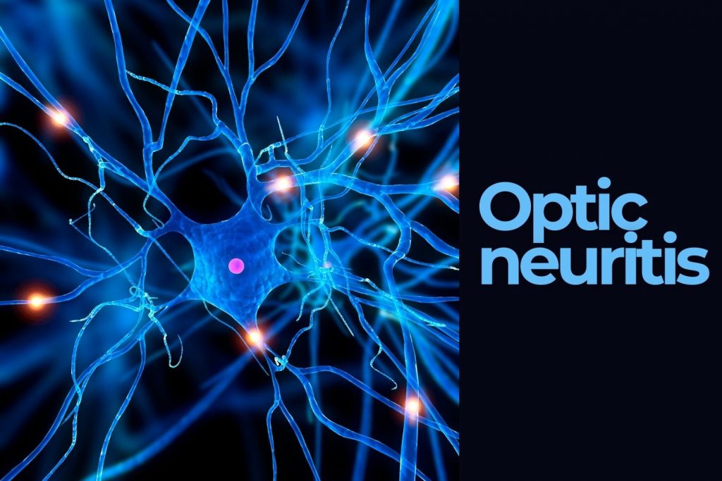 what-is-optic-neuritis-and-how-is-it-connected-to-ms-ezontheeyes