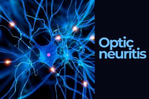 optic neuritis