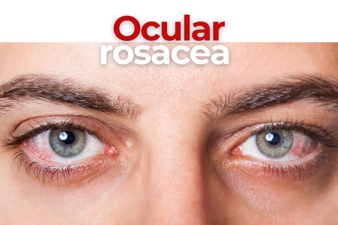 ocular rosacea